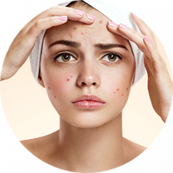 Download PNG image - Acne PNG Background Image 