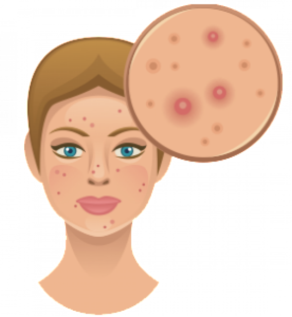 Download PNG image - Acne Vector PNG 