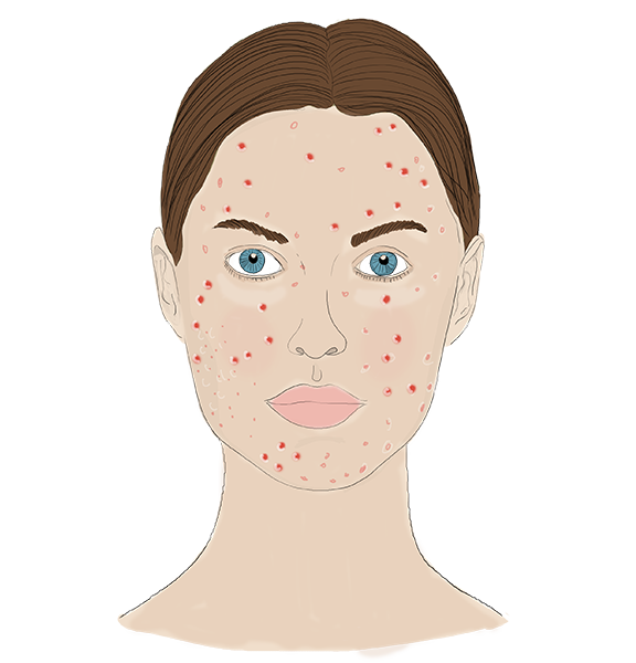 Download PNG image - Acne PNG Free Download 