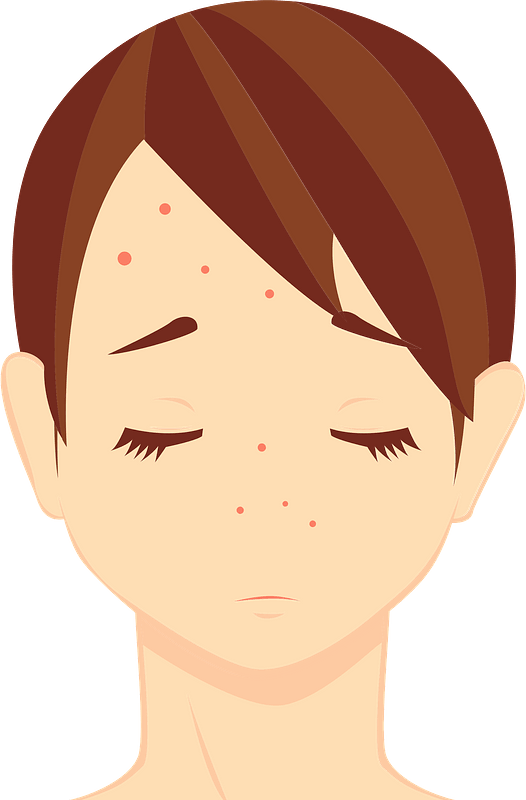 Download PNG image - Acne PNG Picture 